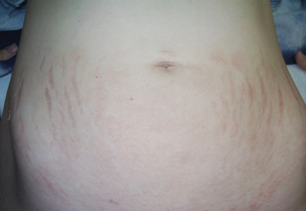 Stretch Marks After Treatment